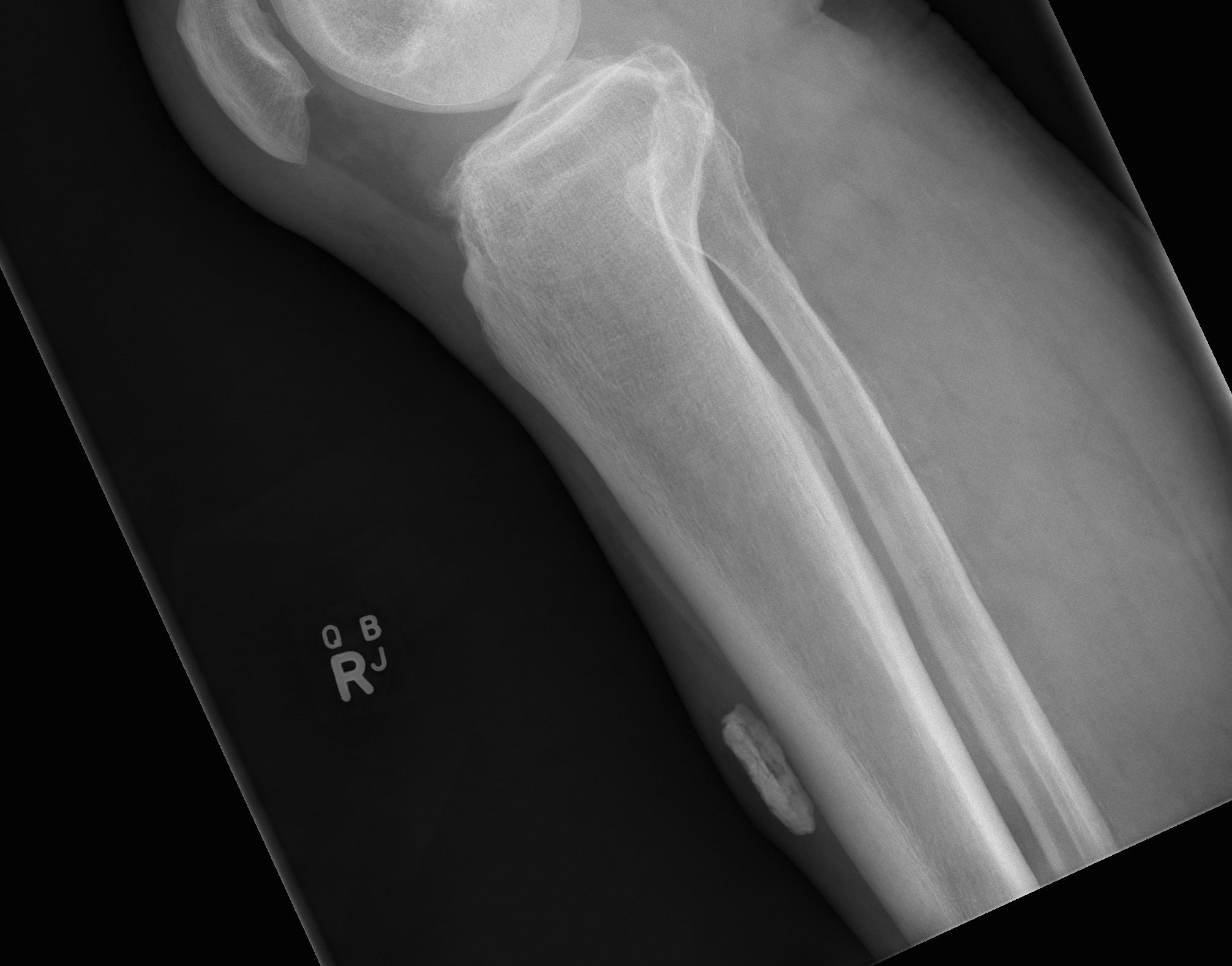 Myositis Ossificans Tibia Lateral